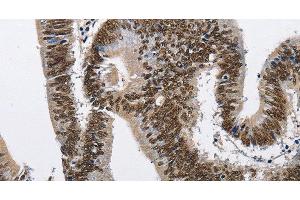 Immunohistochemistry of paraffin-embedded Human colon cancer tissue using CMTM2 Polyclonal Antibody at dilution 1:60