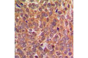 Immunohistochemical analysis of EIF2S1 (pS51) staining in human breast cancer formalin fixed paraffin embedded tissue section. (EIF2S1 antibody  (pSer51))
