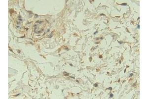 Detection of NRP1 in Human Breast cancer Tissue using Polyclonal Antibody to Neuropilin 1 (NRP1)