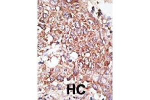 Formalin-fixed and paraffin-embedded human hepatocellular carcinoma tissue reacted with LYVE1 polyclonal antibody  , which was peroxidase-conjugated to the secondary antibody, followed by DAB staining. (LYVE1 antibody  (C-Term))