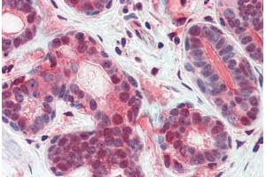 Human Breast (formalin-fixed, paraffin-embedded) stained with ATF6 antibody ABIN351433 at 5 ug/ml followed by biotinylated goat anti-rabbit IgG secondary antibody ABIN481713, alkaline phosphatase-streptavidin and chromogen. (ATF6 antibody  (N-Term))