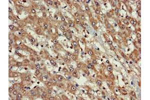 Immunohistochemistry of paraffin-embedded human liver cancer using ABIN7152690 at dilution of 1:100