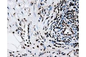 Immunohistochemical staining of paraffin-embedded Adenocarcinoma of colon tissue using anti-RPA2mouse monoclonal antibody. (RPA2 antibody)