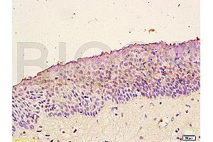 Formalin-fixed and paraffin embedded: human nasopharyngeal carcinoma labeled with Anti-Trk-B Polyclonal Antibody (ABIN725870), Unconjugated at 1:200 followed by conjugation to the secondary antibody and DAB staining (TRKB antibody  (AA 401-500))