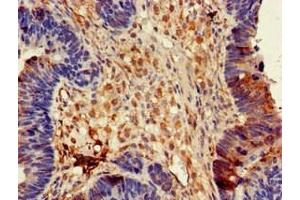 Immunohistochemistry of paraffin-embedded human ovarian cancer using ABIN7149934 at dilution of 1:100 (DPYSL4 antibody  (AA 280-560))
