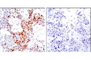 Immunohistochemical analysis of paraffin-embedded breast carcinoma.