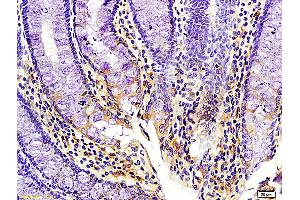 Formalin-fixed and paraffin embedded human colon cancer Rabbit Anti-Kiss 1/Kisspeptin Polyclonal Antibody (ABIN672726), Unconjugated 1:200 followed by conjugation to the secondary antibody and DAB staining. (KISS1 antibody  (AA 81-145))