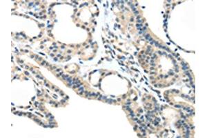 The image on the left is immunohistochemistry of paraffin-embedded Human thyroid cancer tissue using ABIN7193032(VSIG10 Antibody) at dilution 1/45, on the right is treated with synthetic peptide. (VSIG1 antibody)