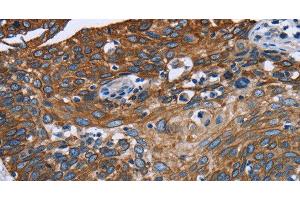 Immunohistochemistry of paraffin-embedded Human cervical cancer tissue using FCGR3A Polyclonal Antibody at dilution 1:40 (FCGR3A antibody)