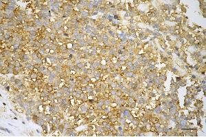 Immunohistochemistry was performed on paraffin-embedded human breast carcinoma using GAPDH antibody (ABIN7798768), 1:500). (Recombinant GAPDH antibody)