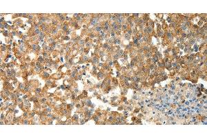 Immunohistochemistry of paraffin-embedded Human breast cancer using PRDX3 Polyclonal Antibody at dilution of 1:50 (Peroxiredoxin 3 antibody)