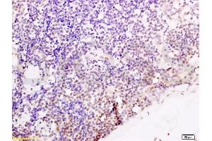 Formalin-fixed and paraffin embedded human endometrium carcinoma tissue labeled with Anti-Cyclin G Polyclonal Antibody, Unconjugated (ABIN685837) at 1:200 followed by conjugation to the secondary antibody and DAB stainin (Cyclin G1 antibody  (AA 181-295))