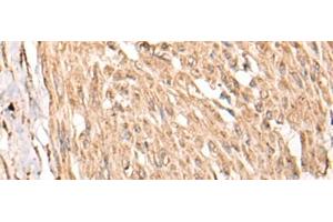Immunohistochemistry of paraffin-embedded Human cervical cancer tissue using HSF4 Polyclonal Antibody at dilution of 1:55(x200) (HSF4 antibody)