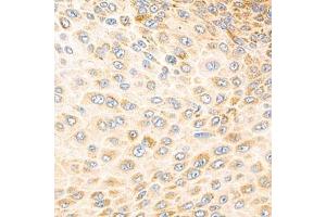 Immunohistochemistry analysis of paraffin-embedded human esophageal cancer using Torsin A (ABIN7075942) at dilution of 1: 800 (TOR1A antibody)