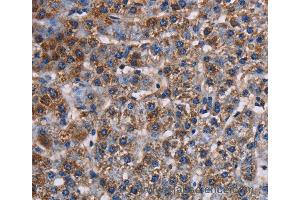 Immunohistochemistry of Human lung cancer using KCNK1 Polyclonal Antibody at dilution of 1:50 (KCNK1 antibody)