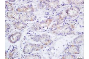 Formalin-fixed and paraffin embedded human gastric cancer labeled with Anti-Phospho-eNOS (Ser1177)Polyclonal Antibody, Unconjugated  at 1:200 followed by conjugation to the secondary antibody and DAB staining (ENOS antibody  (pSer1177))