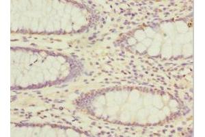 Immunohistochemistry of paraffin-embedded human colon cancer using ABIN7143282 at dilution of 1:100 (ADAD1 antibody  (AA 1-280))