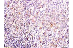 Formalin-fixed and paraffin embedded mouse lymphoma tissue labeled with Anti-DUSP1/MKP-1 Polyclonal Antibody, Unconjugated (ABIN735368) at 1:200, followed by conjugation to the secondary antibody and DAB staining