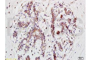 Formalin-fixed and paraffin embedded human breast carcinoma tissue labeled with Anti-BRMS-1 Polyclonal Antibody, Unconjugated (ABIN730933) at 1:200 followed by conjugation to the secondary antibody and DAB staining (BRMS1L antibody  (AA 151-246))