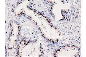 Immunohistochemical staining of paraffin-embedded Adenocarcinoma of Human colon tissue using anti-SOCS3 mouse monoclonal antibody. (SOCS3 antibody)