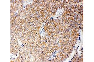 IHC-P: Caspase-12 antibody testing of human lung cancer tissue (Caspase 12 antibody  (AA 71-84))