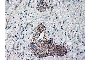Immunohistochemical staining of paraffin-embedded Adenocarcinoma of Human breast tissue using anti-APBB3 mouse monoclonal antibody. (APBB3 antibody)