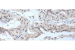 Immunohistochemistry of paraffin-embedded Human liver cancer tissue using TBX1 Polyclonal Antibody at dilution of 1:40(x200) (T-Box 1 antibody)