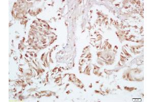 Formalin-fixed and paraffin embedded human colon carcinoma labeled with Rabbit Anti-P70 S6 Kinase beta 2 (Ser370) Polyclonal Antibody, Unconjugated 1:200 followed by conjugation to the secondary antibody and DAB staining (RPS6KB2 antibody  (pSer370))