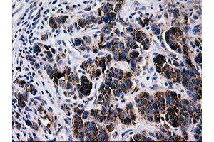 Immunohistochemical staining of paraffin-embedded Carcinoma of Human lung tissue using anti-LGALS3BP mouse monoclonal antibody. (LGALS3BP antibody)