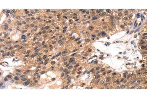 Immunohistochemistry of paraffin-embedded Human breast cancer using TLN1 Polyclonal Antibody at dilution of 1:35 (TLN1 antibody)