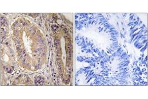 Immunohistochemistry analysis of paraffin-embedded human colon carcinoma tissue, using FAK (Ab-843) Antibody. (FAK antibody  (AA 809-858))