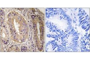 Immunohistochemistry analysis of paraffin-embedded human colon carcinoma tissue, using FAK (Ab-843) Antibody.