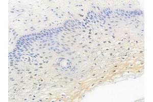 ABIN6255654 and ABIN6267462 at 1/100 staining human cervical carcinoma by IHC-P.