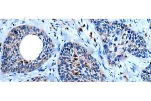Immunohistochemistry of paraffin-embedded Human cervical cancer tissue using WISP2 Polyclonal Antibody at dilution of 1:45(x200) (WISP2 antibody)