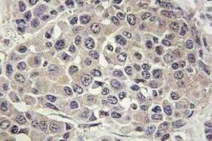 Immunohistochemistry (IHC) analyzes of p-p70 S6 kinase alpha antibody in paraffin-embedded human breast carcinoma tissue. (RPS6KB1 antibody  (pSer447))