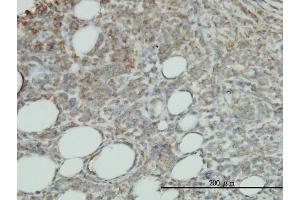 Immunoperoxidase of monoclonal antibody to PROCR on formalin-fixed paraffin-embedded human malignant lymphoma, diffuse large B tissue. (PROCR antibody  (AA 1-238))
