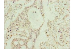 Immunohistochemistry of paraffin-embedded human pancreatic cancer using ABIN7148371 at dilution of 1:100 (C8B antibody  (AA 55-350))