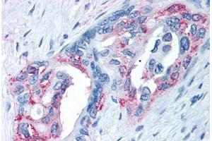 Anti-TRPM8 antibody  ABIN1049436 IHC staining of human prostate carcinoma.