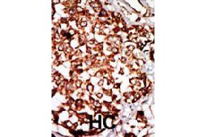 Formalin-fixed and paraffin-embedded human hepatocellular carcinoma tissue reacted with NRBP1 polyclonal antibody  , which was peroxidase-conjugated to the secondary antibody, followed by DAB staining. (NRBP1 antibody  (N-Term))