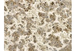 ABIN6255351 and ABIN6267196 at 1/100 staining human renal cell carcinoma by IHC-P. (TPT1 antibody  (pSer46))