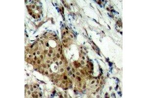 Immunohistochemical analysis of CDK11B staining in human breast cancer formalin fixed paraffin embedded tissue section. (CDK11 antibody  (N-Term))