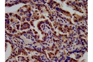 IHC image of ABIN7171895 diluted at 1:700 and staining in paraffin-embedded human lung cancer performed on a Leica BondTM system.