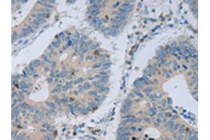 The image on the left is immunohistochemistry of paraffin-embedded Human colon cancer tissue using ABIN7130139(MAGEB4 Antibody) at dilution 1/40, on the right is treated with fusion protein. (MAGEB4 antibody)