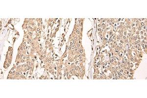 Immunohistochemistry of paraffin-embedded Human prost ate cancer tissue using ATAD3A Polyclonal Antibody at dilution of 1:40(x200) (ATAD3A antibody)