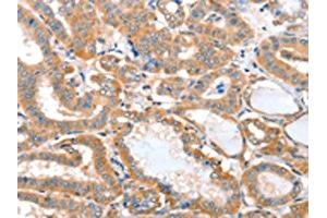 The image on the left is immunohistochemistry of paraffin-embedded Human thyroid cancer tissue using ABIN7128162(ACOT11 Antibody) at dilution 1/25, on the right is treated with fusion protein. (ACOT11 antibody)