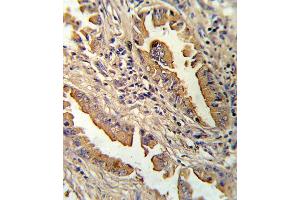 Formalin-fixed and paraffin-embedded human lung carcinoma reacted with IL8 Antibody (C-term), which was peroxidase-conjugated to the secondary antibody, followed by DAB staining. (IL-8 antibody  (C-Term))