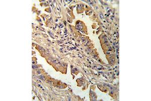 Formalin-fixed and paraffin-embedded human lung carcinoma reacted with IL8 Antibody (C-term), which was peroxidase-conjugated to the secondary antibody, followed by DAB staining. (IL-8 antibody  (C-Term))