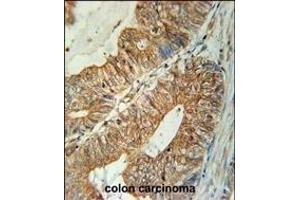 TSN3 Antibody (Center) (ABIN651749 and ABIN2840386) immunohistochemistry analysis in formalin fixed and raffin embedded human colon carcinoma followed by peroxidase conjugation of the secondary antibody and DAB staining. (Tetraspanin 3 antibody  (AA 90-117))