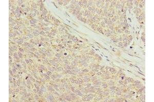 Immunohistochemistry of paraffin-embedded human ovarian cancer using ABIN7162575 at dilution of 1:100 (Pancreatic Progenitor Cell Differentiation and Proliferation Factor-Like Protein (PPDPFL) (AA 1-81) antibody)