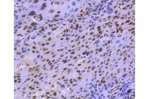Paraformaldehyde-fixed, paraffin embedded human lung carcinoma, Antigen retrieval by boiling in sodium citrate buffer (pH6) for 15min, Block endogenous peroxidase by 3% hydrogen peroxide for 30 minutes, Blocking buffer (normal serum) at 37°C for 20min, Antibody incubation with HDAC8 (4C3) Monoclonal Antibody  at 1:50 overnight at 4°C, followed by a conjugated secondary and DAB staining. (HDAC8 antibody)